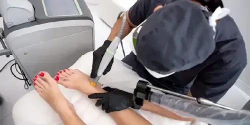 How Much Does Laser Surgery for Varicose Veins Cost?